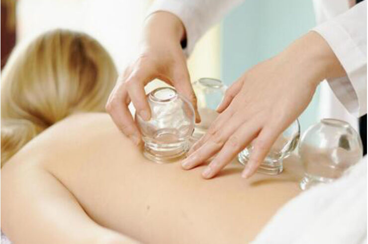 カッピング